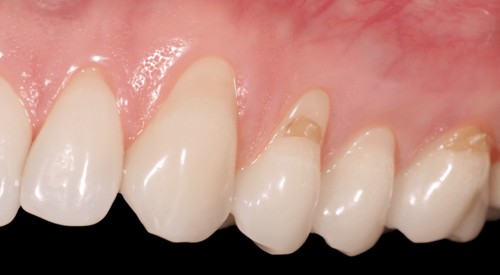 Couverture de récessions multiples avec une matrice dermique acellulaire