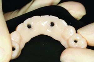 prothèse transitoire