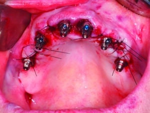 implants et piliers