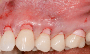 récessions gingivales