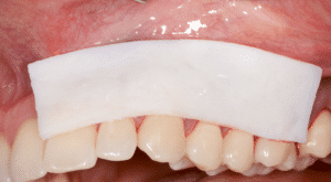 récessions gingivales