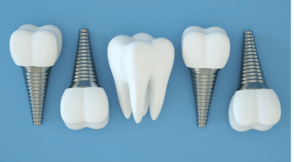 12 mauvaises raisons de ne pas faire (plus) d’implants