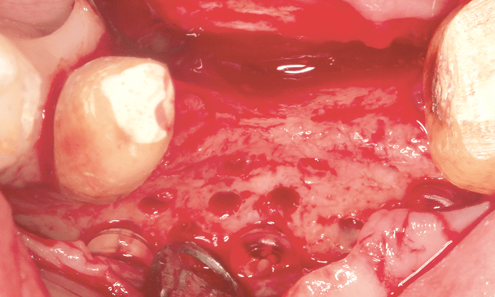 incision crestale et incisions