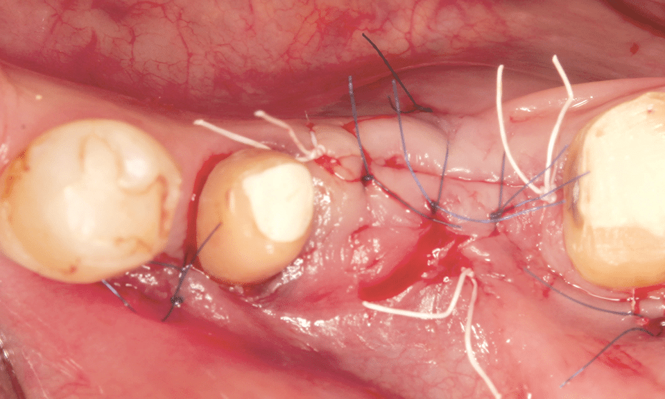 sutures horizontales croisées profondes
