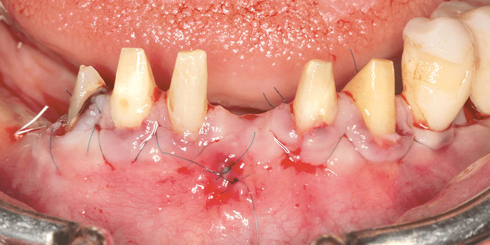 incisions intrasulculaires