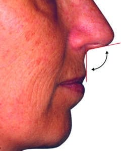 angle nasolabial