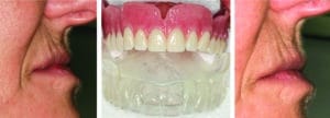 smile design