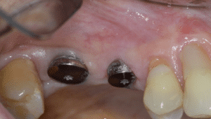 implant