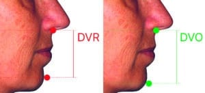 DVR DVO