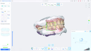 enregistrement de l'occlusion