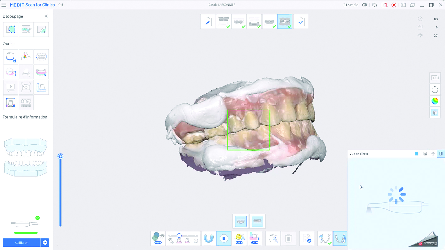 enregistrement de l'occlusion