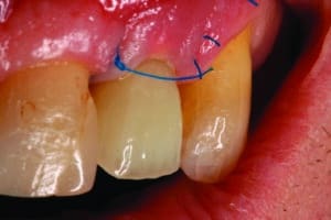 suture