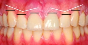 symétrie gingivale