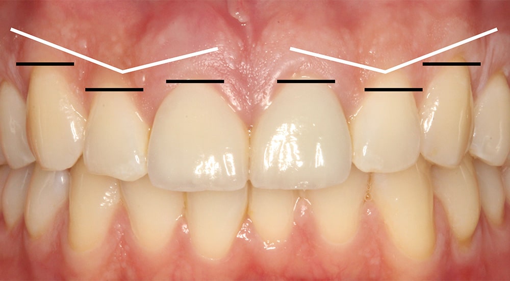 Réhabilitation complète - symétrie gingivale