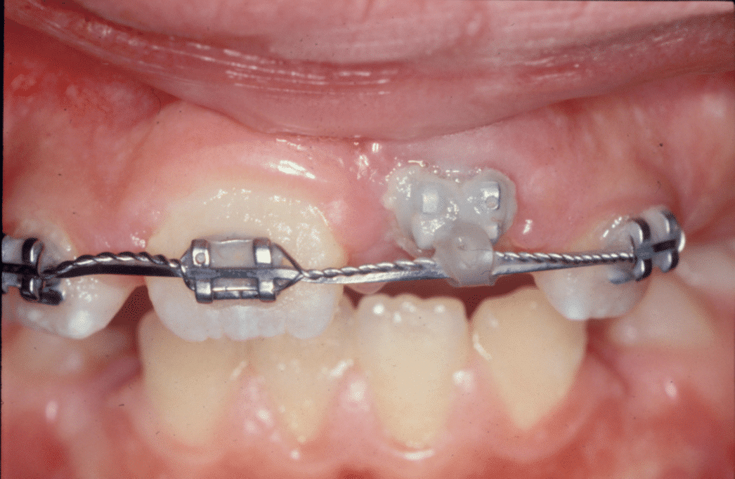 traitement orthodontique