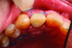 dépose des sutures