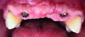 implants 