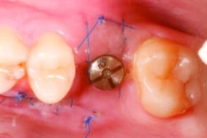 implant