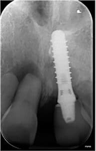 implant