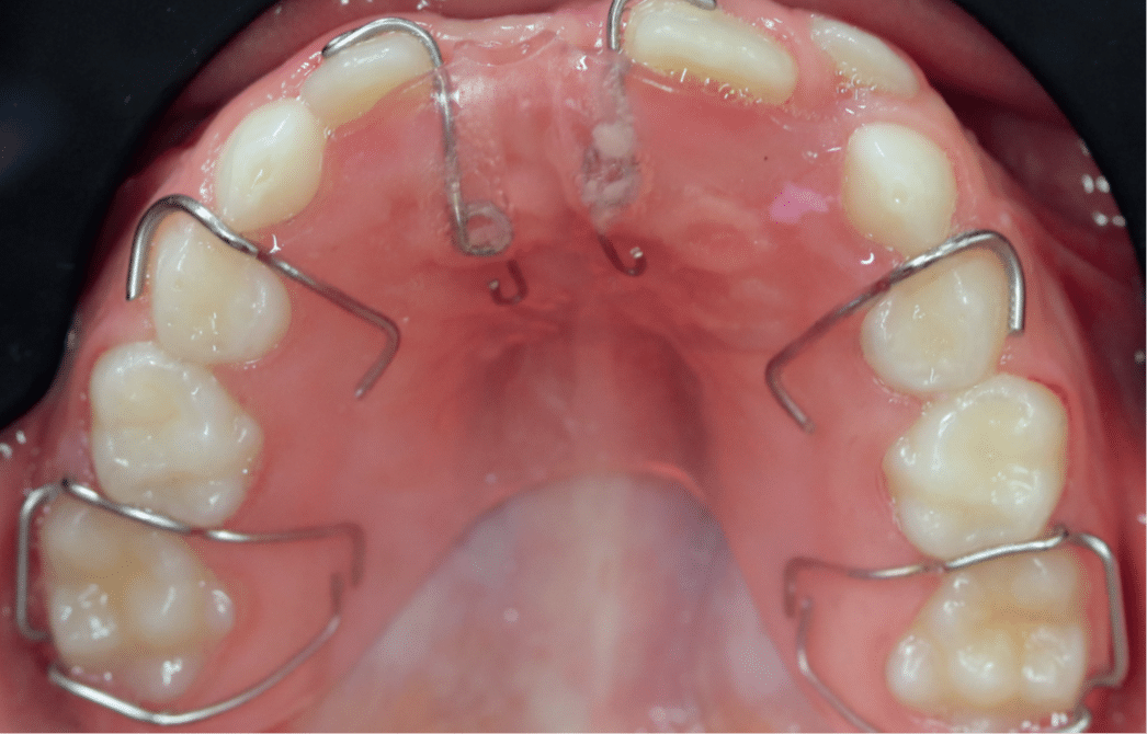 remplacement de dents absentes