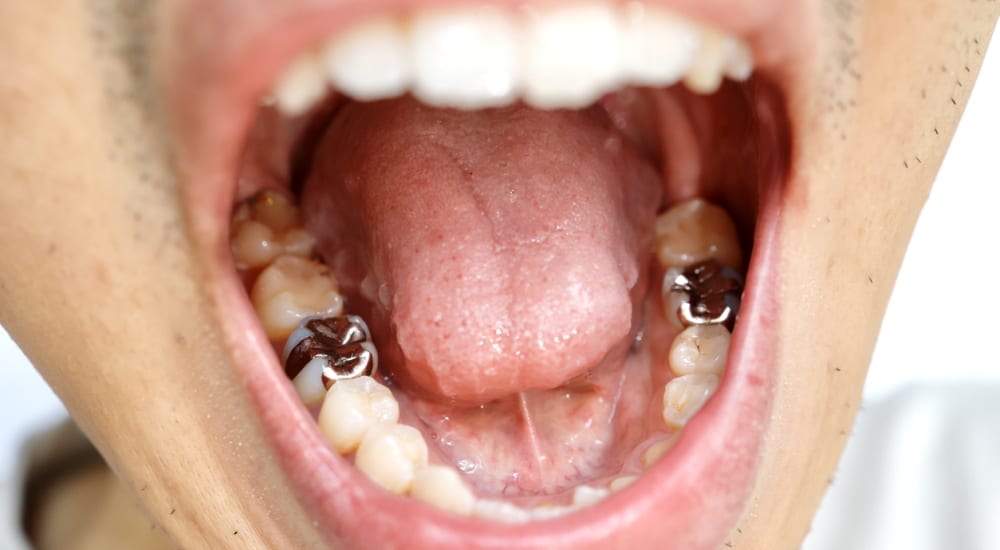 amalgames dentaires interdiction europe