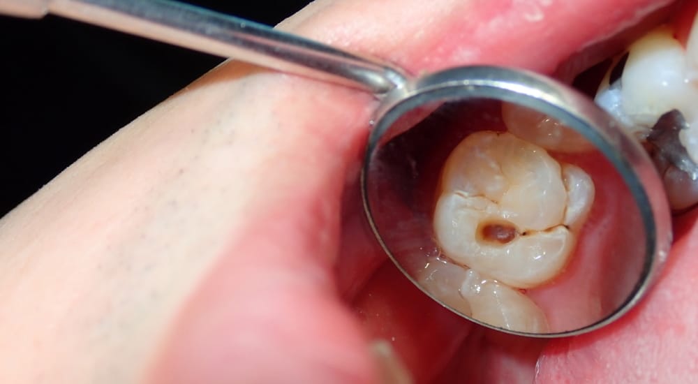 Enquête ReCol : mieux diagnostiquer et soigner les caries