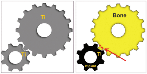 causes des micro fractures.