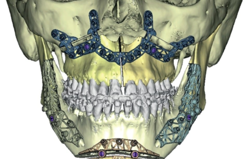 histoire raisonnée de la chirurgie orthognathique