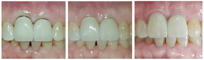 modifications de la ligne gingivale distale