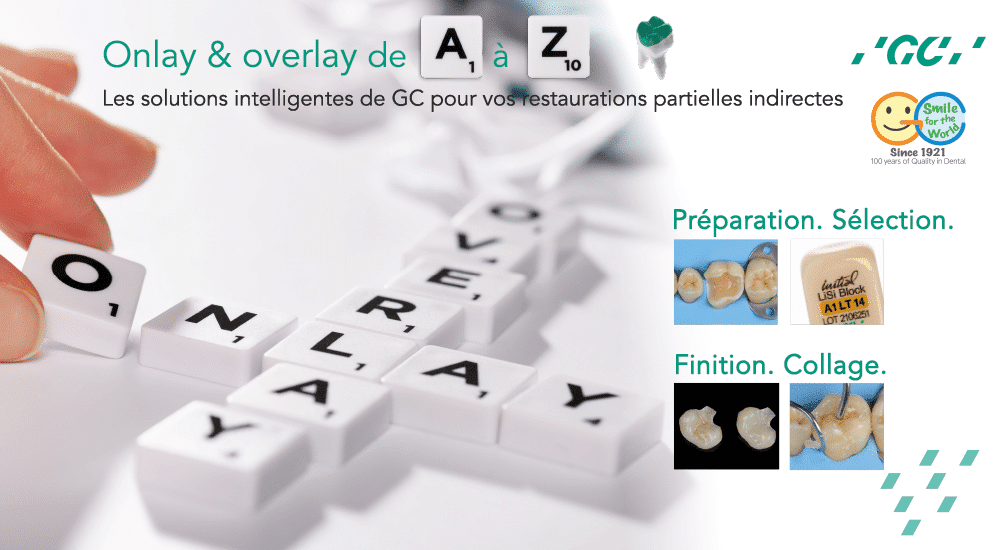 Onlay & overlay de A à Z