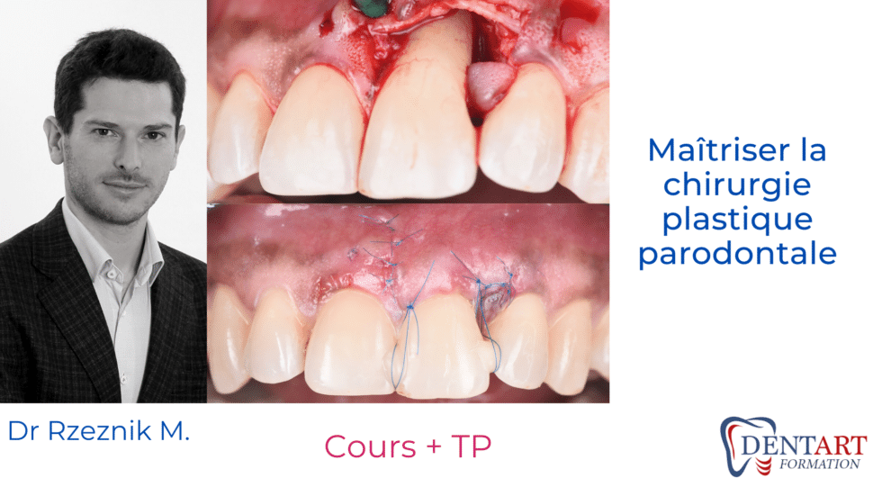 parodontie chirurgicale ok 980x551 1