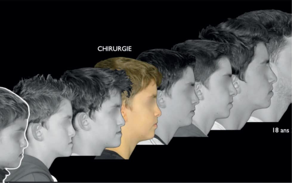 traitement orthodontico chirurgical du patient en cours de croissance