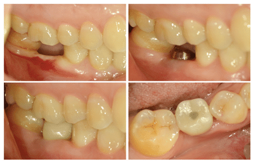 traitement prothétique implantaire réussi