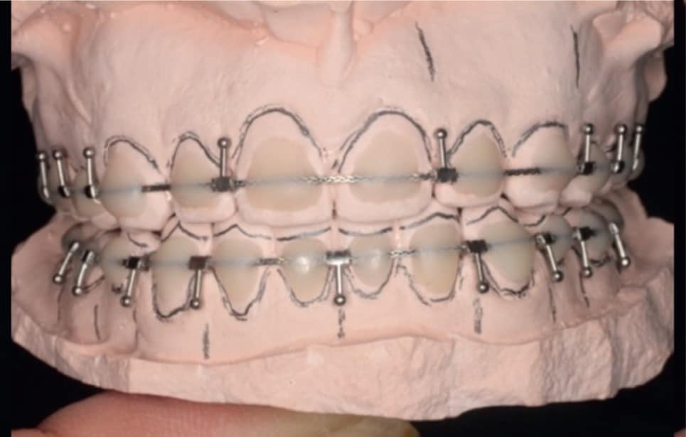 traitements orthodontico chirurgicaux par aligneurs