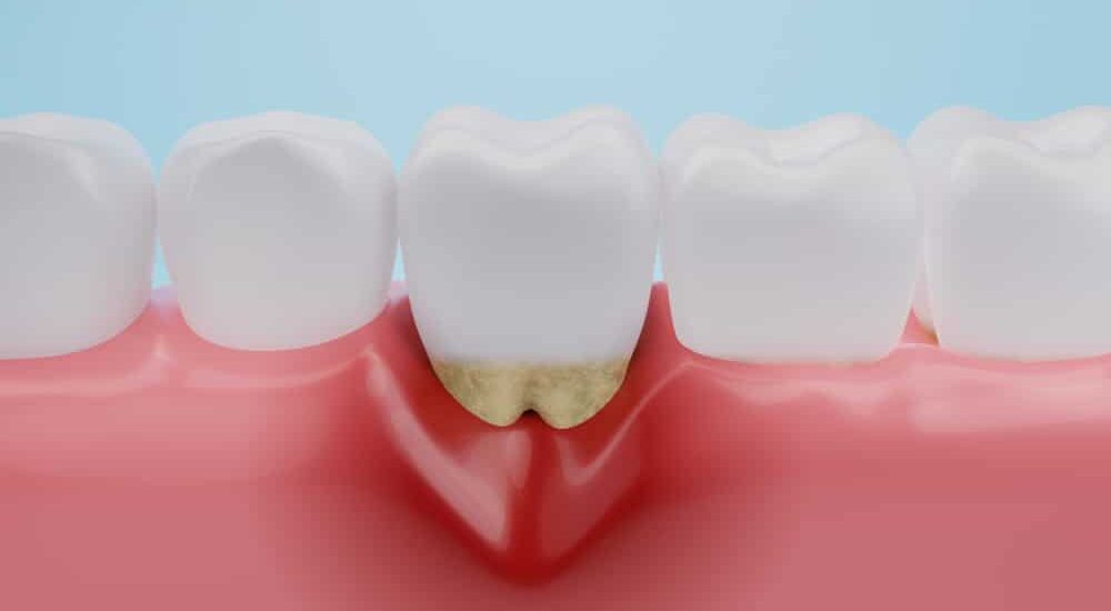 Les archéologues de la plaque dentaire