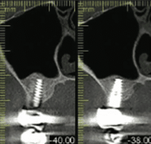 CBCT à deux ans