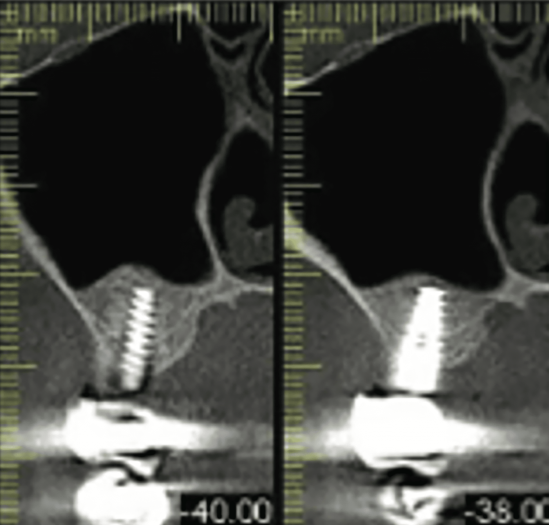 CBCT à deux ans