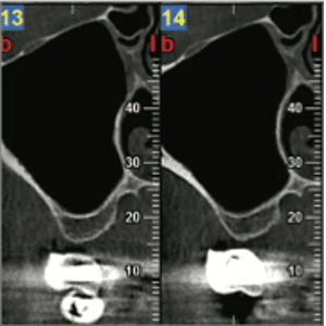 CBCT préopératoire