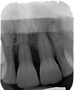 Évaluation radiographique de la lésion.