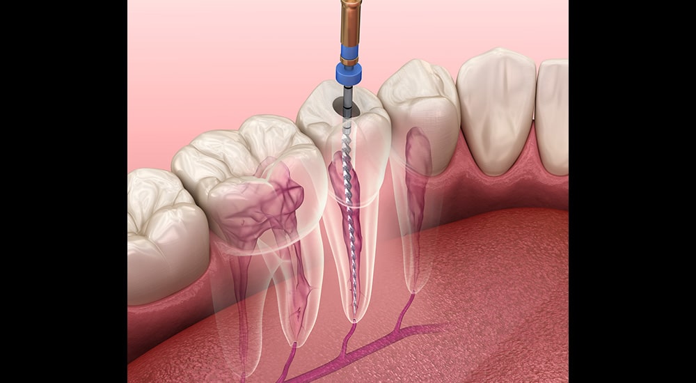 irrigation endodontique
