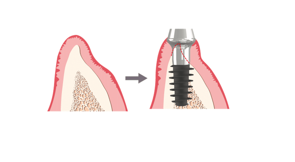Implant conçu pour un traitement minimalement invasif