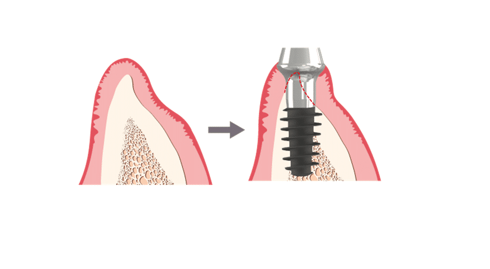 implant magicore