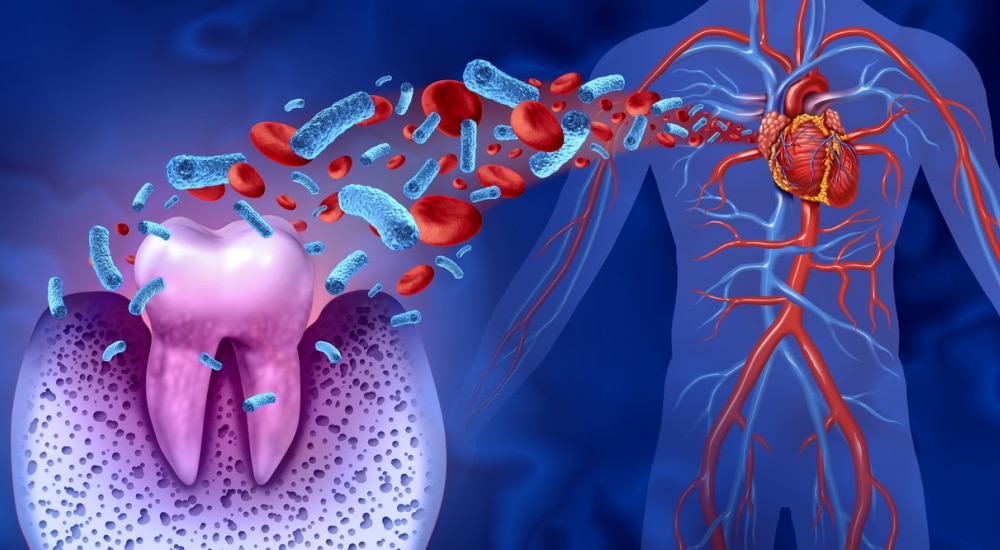 La bactérie buccale P. gingivalis aggraverait les dommages causés par une crise cardiaque