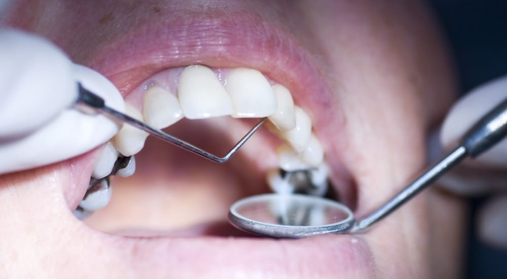Inquiétudes autour de l’interdiction des amalgames dentaires en 2025