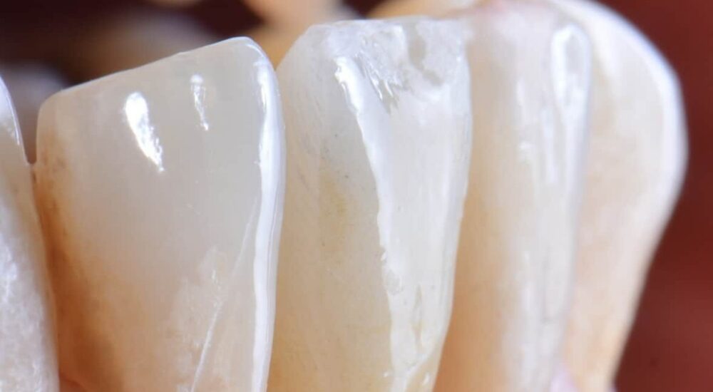Apport de la chirurgie plastique parodontale dans la réalisation d’un bridge collé cantilever