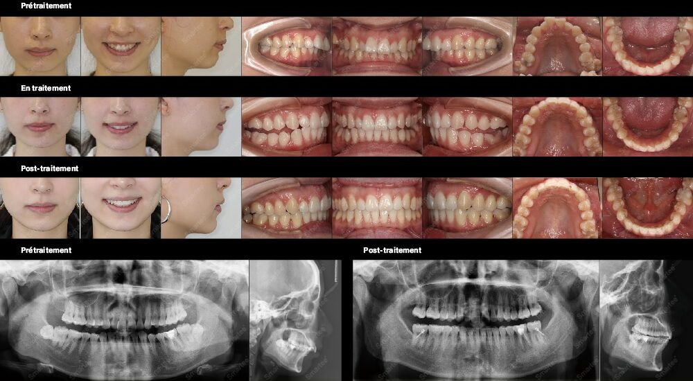 Smartee crée un nouvel aligneur transparent – Smartee GS pour corriger les anomalies de Classe II sévères