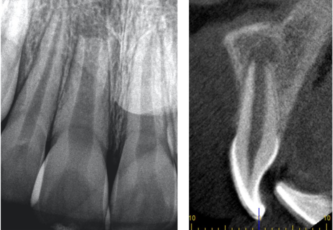 soin dent immature nécrosée