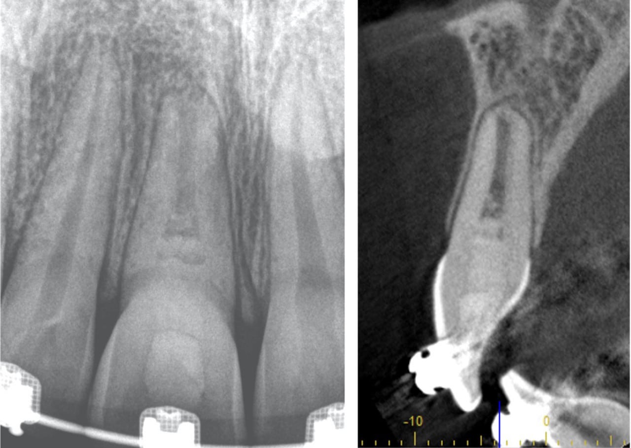 revitalisation dents permanentes immatures nécrosées