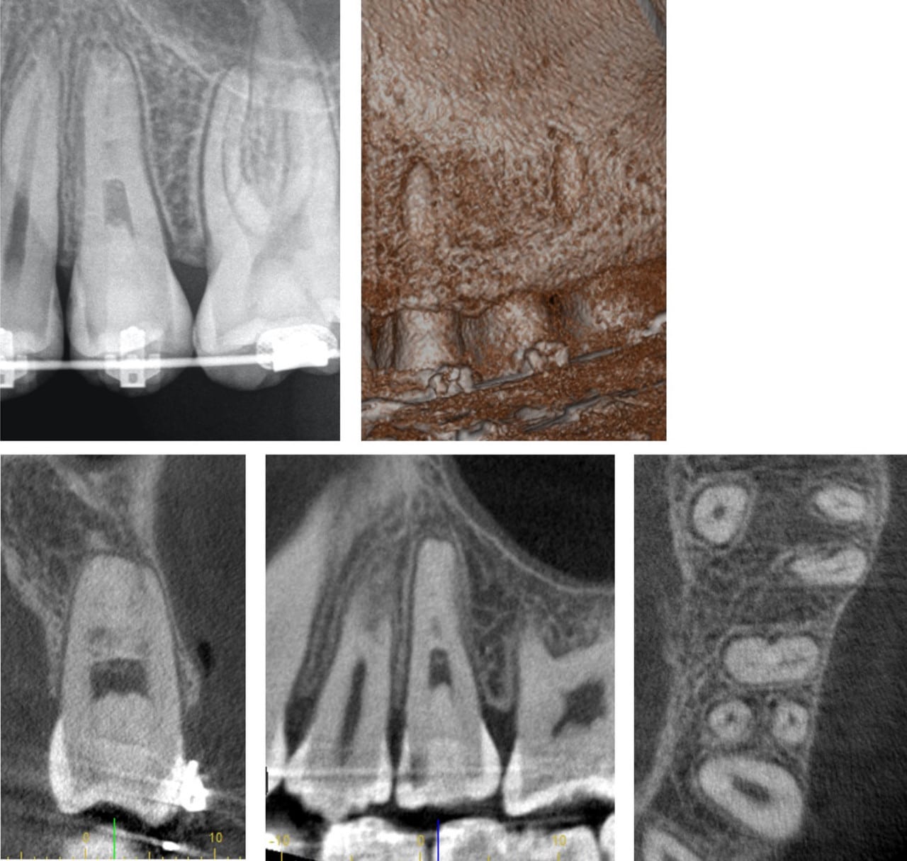revitalisation dent immature nécrosée