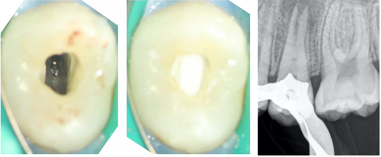 revitalisation des dents permanentes immatures nécrosées